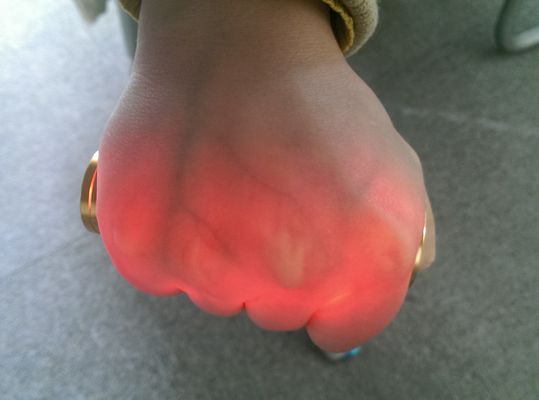 Venipuncture Infrared Vein Finder