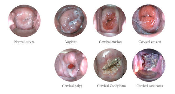 पोर्टेबल डिजिटल इलेक्ट्रॉनिक कोलपोस्कोप