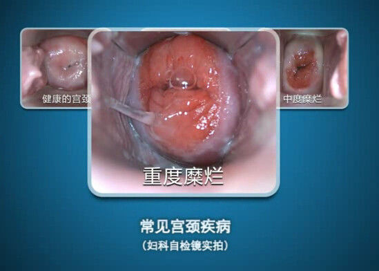 डिजिटल एंडोस्कोप आत्म निरीक्षण Colposcope अवलोकन की सीमा के साथ मिनी Colposcopy 70 ~ 100 मिमी