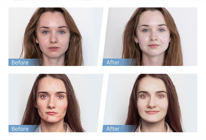 फ़ैक्टरी सेल हाइड्रा पेन H5 ईएमएस इलेक्ट्रिकल माइक्रोनीडलिंग पेन, कोलेजन पुनर्जनन, बाल और दाढ़ी के पुनर्विकास के लिए, घर और सैलून में उपयोग के लिए 4